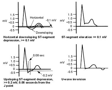 Ordering and Understanding the Exercise Stress Test .